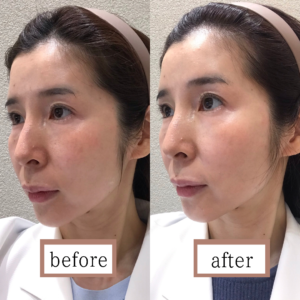 プロファイロ症例写真