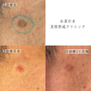 炭酸ガスレーザー治療後の経過