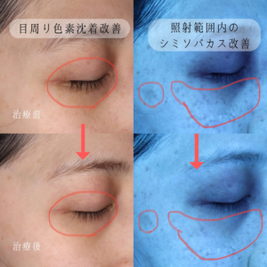 目周りの色素沈着 ピコトーニング経過