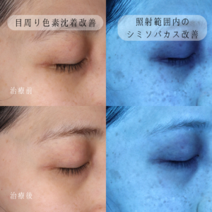 目周りの色素沈着 治療後