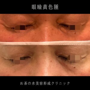眼瞼黄色腫 治療後