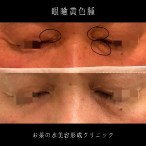 眼瞼黄色腫 治療前