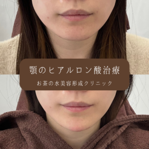 顎ヒアルロン酸 症例写真1