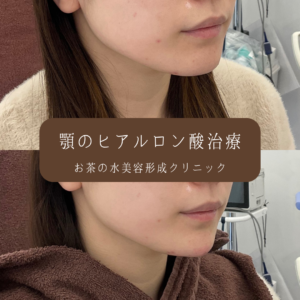 顎ヒアルロン酸 症例写真2