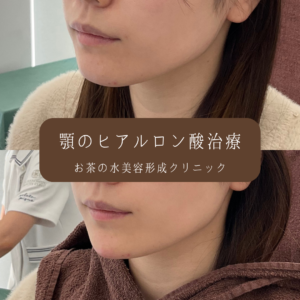 顎ヒアルロン酸 症例写真3