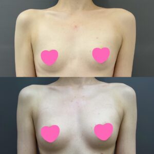 二の腕脂肪吸引と脂肪豊胸の症例写真