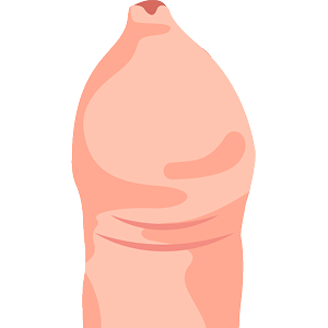 真性包茎