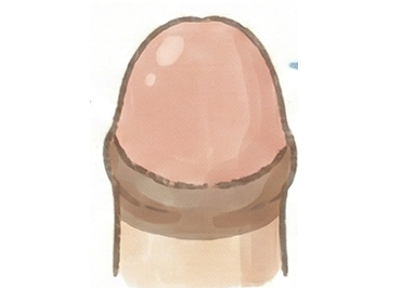 環状切開法のイメージ図