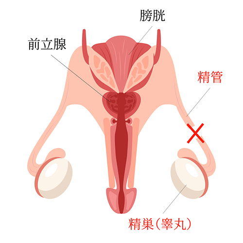 パイプカット 
