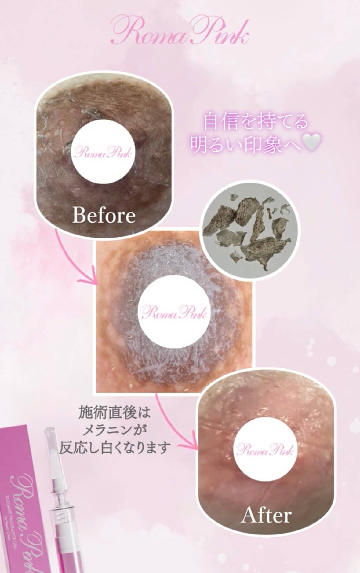 ROMAPINK施術のイメージ