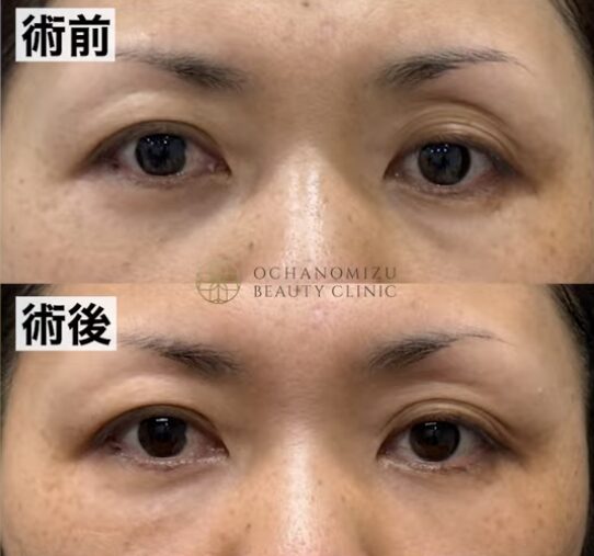 修正手術の術前術後比較