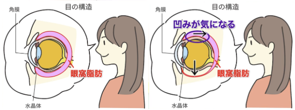 上まぶたのへこみのメカニズム