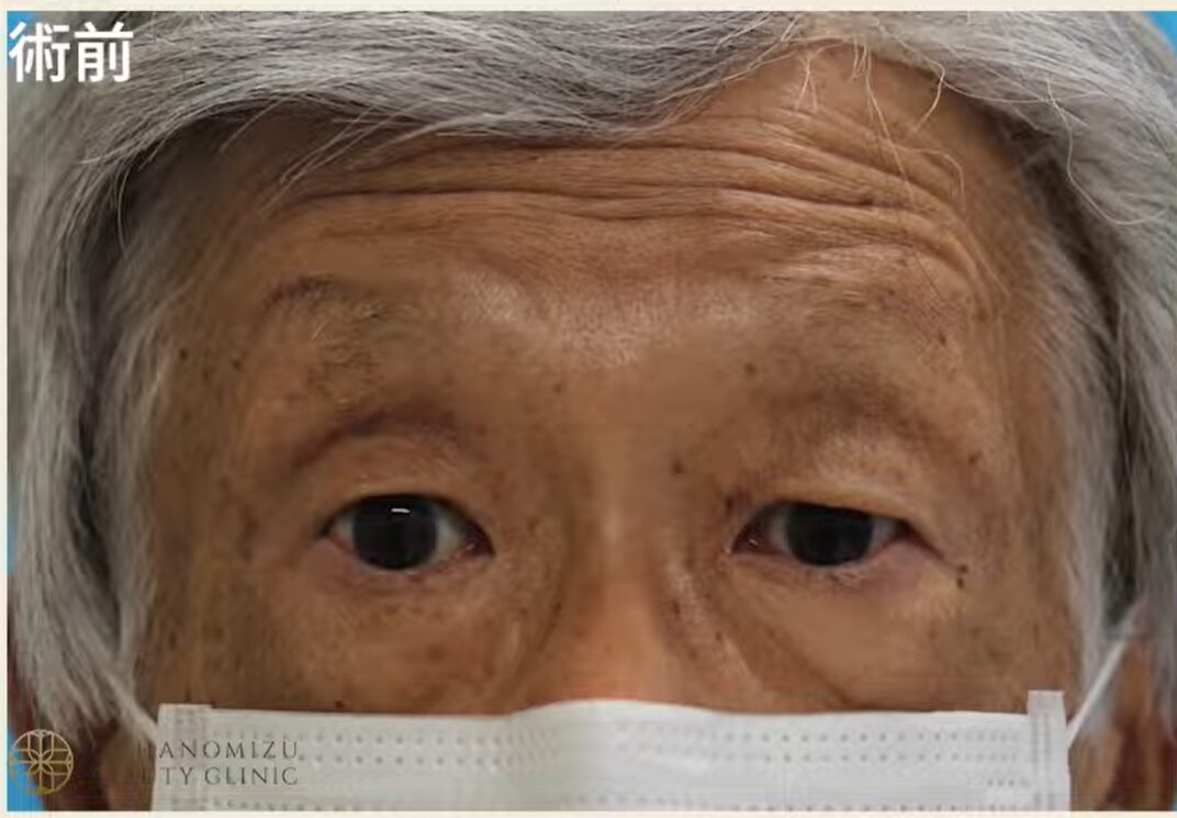 眼瞼下垂の症状例