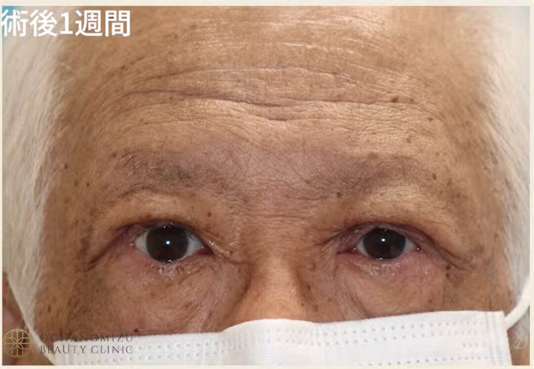 眼瞼下垂の症例写真2