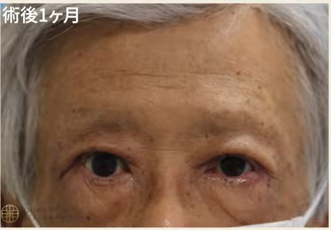 眼瞼下垂の症例写真3