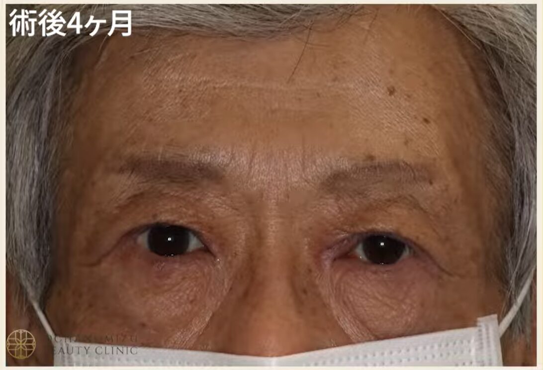 眼瞼下垂の症例写真4