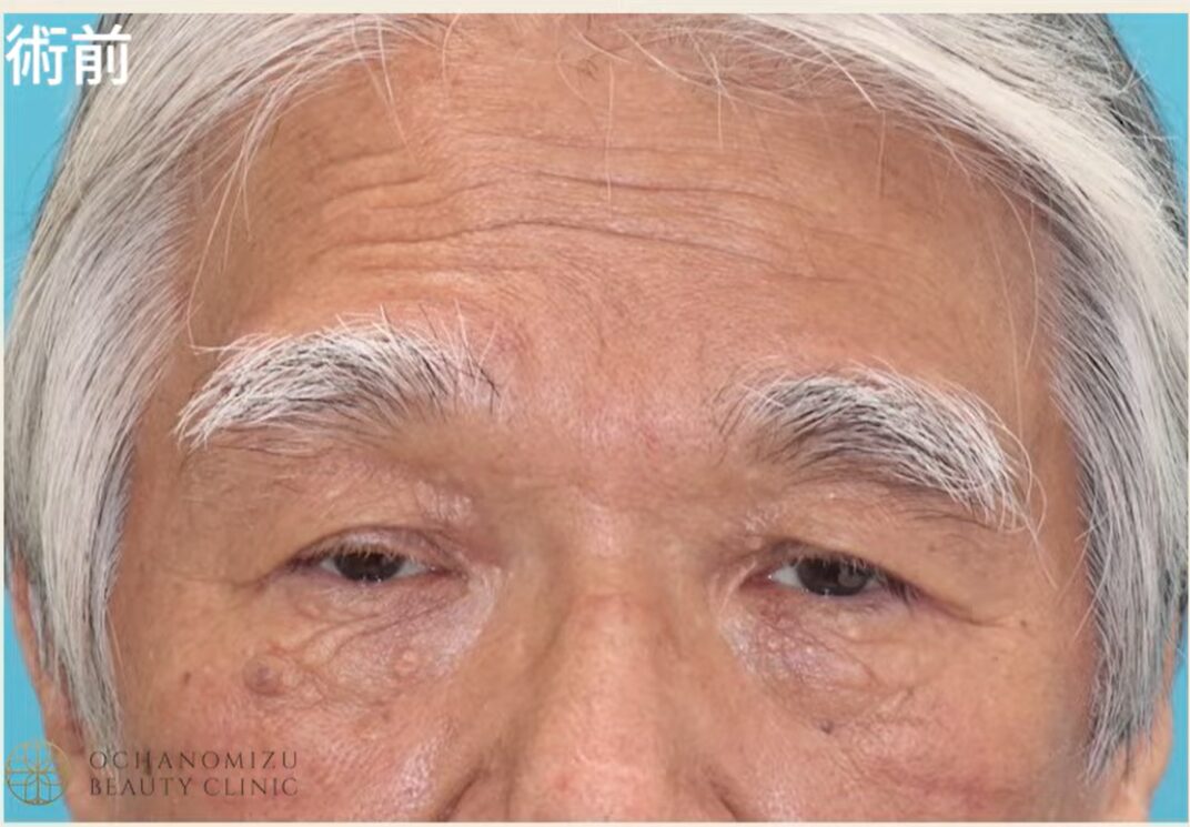 術後の変化1