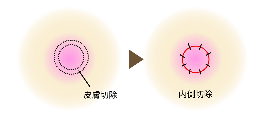 乳頭基部切開