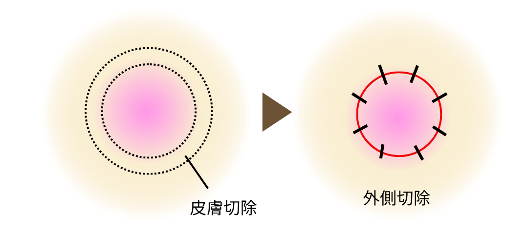 乳輪周囲切開
