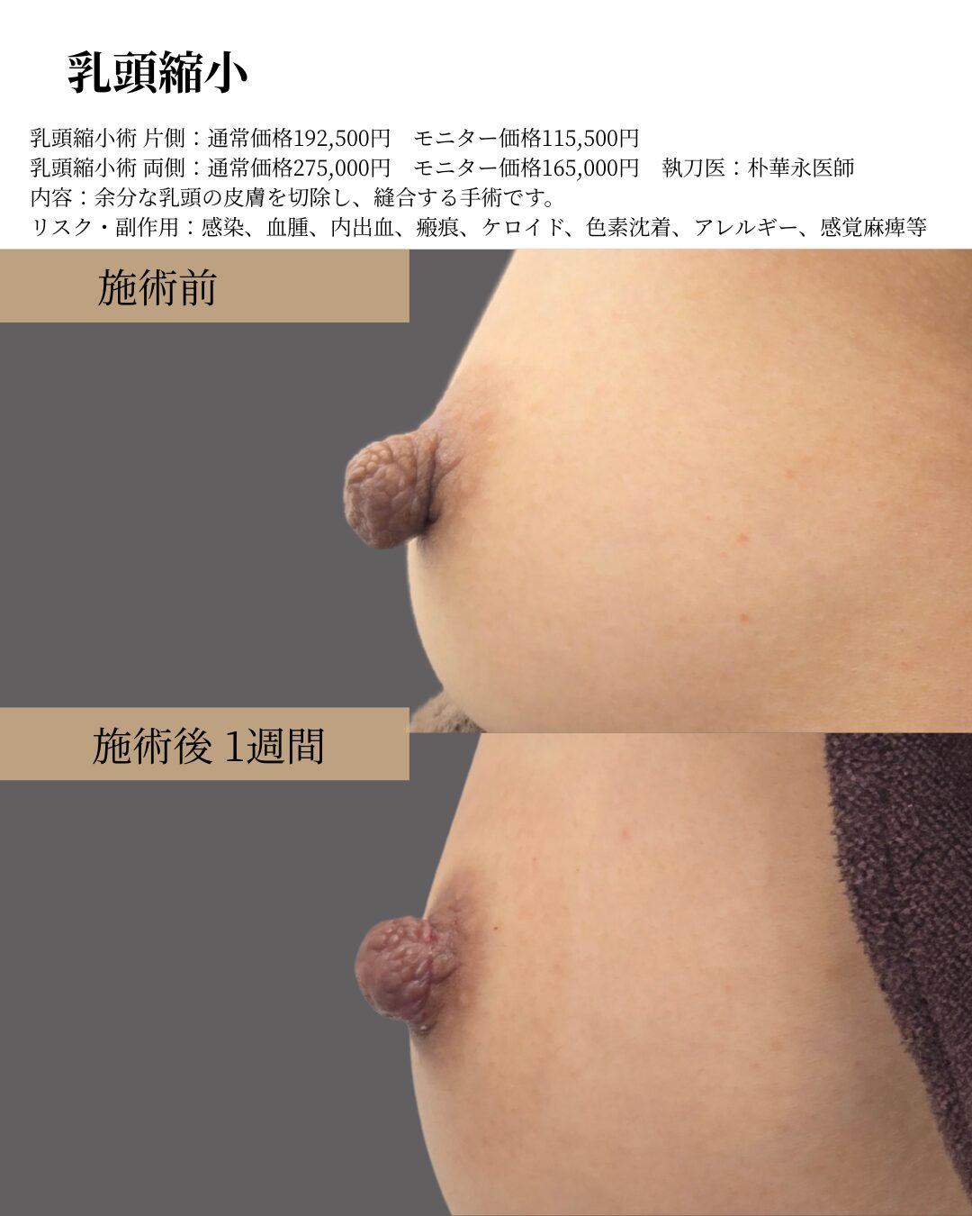 乳頭縮小