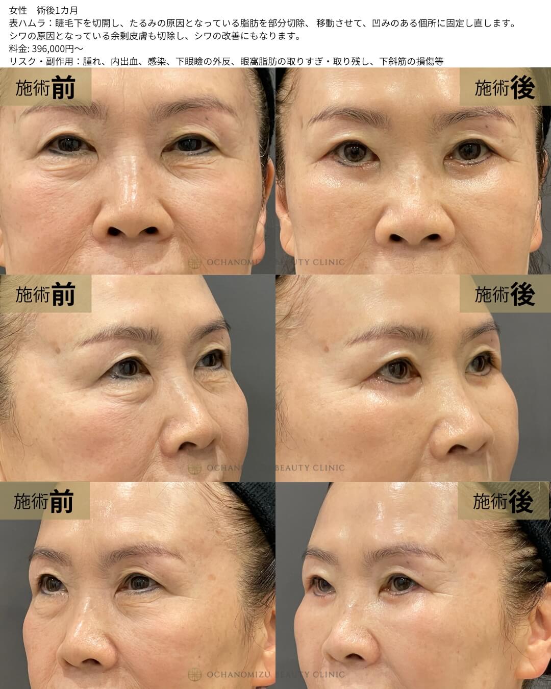 表ハムラ