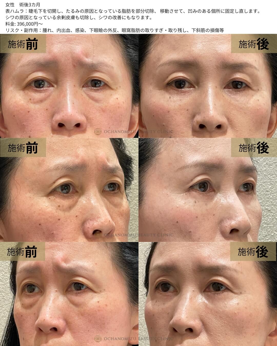 表ハムラ