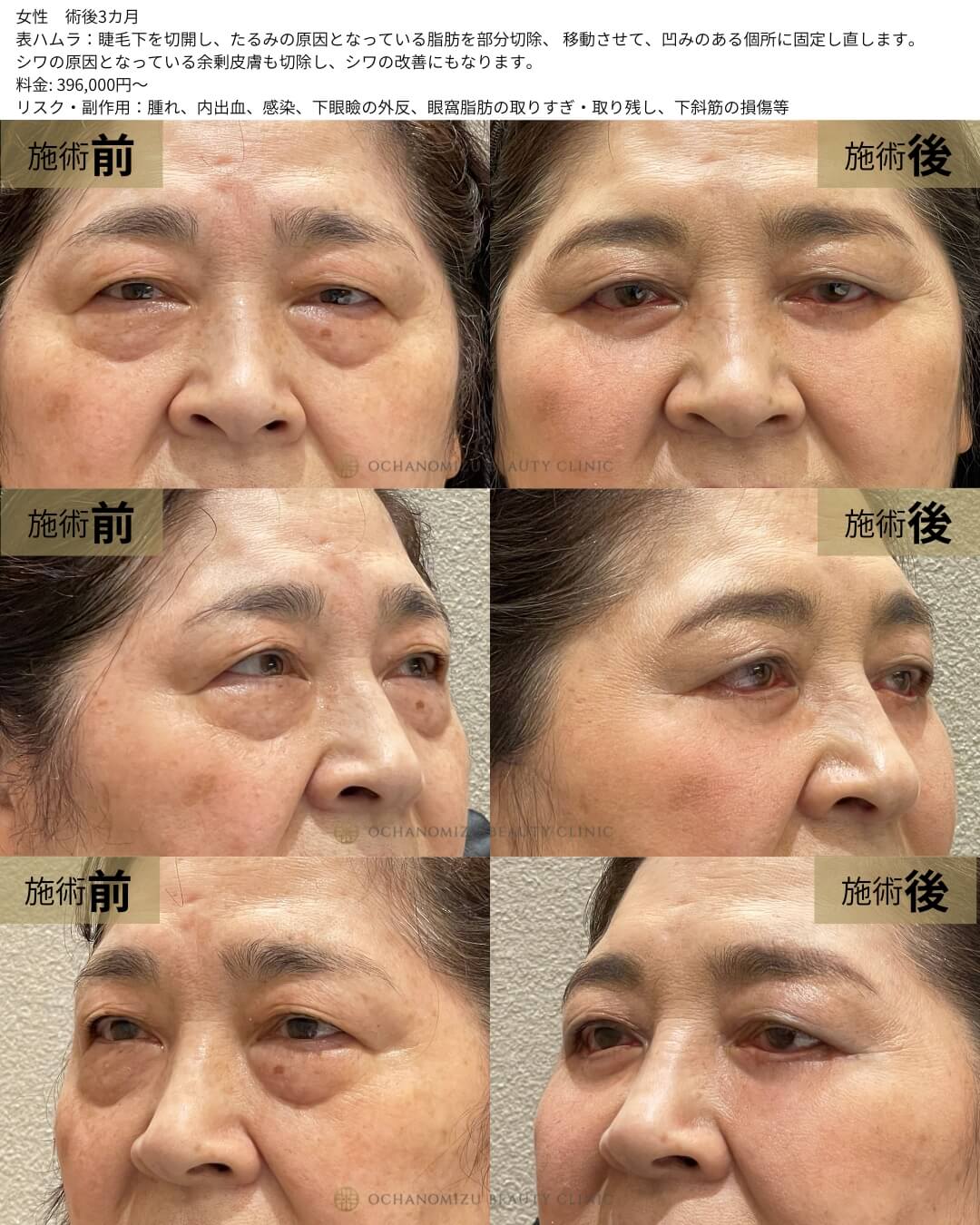 表ハムラ