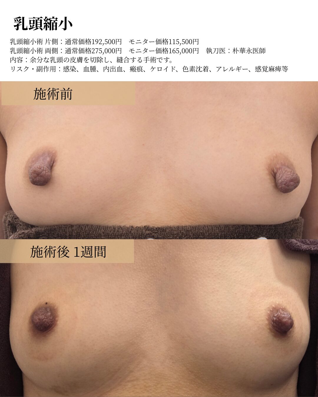 乳頭縮小