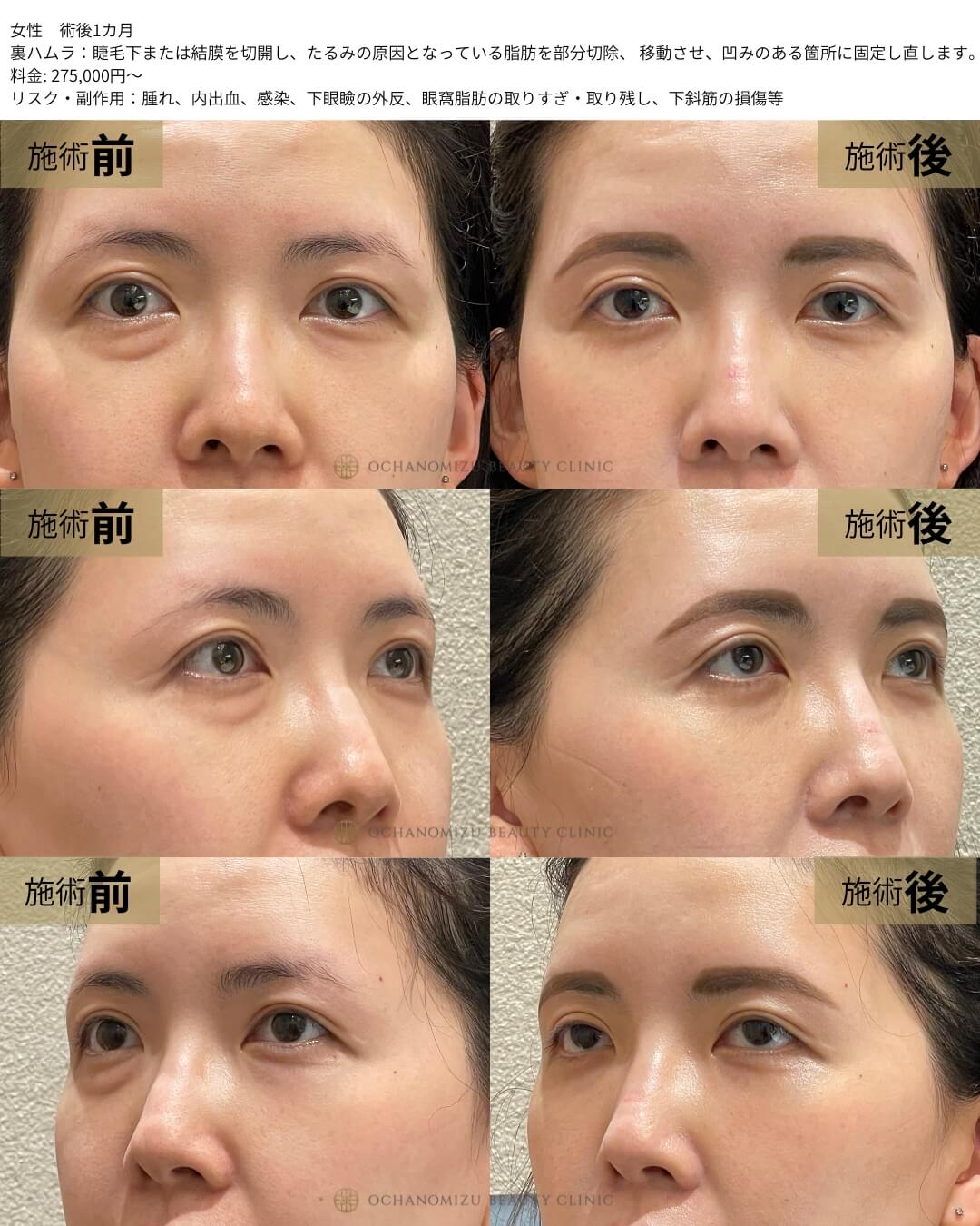 裏ハムラ