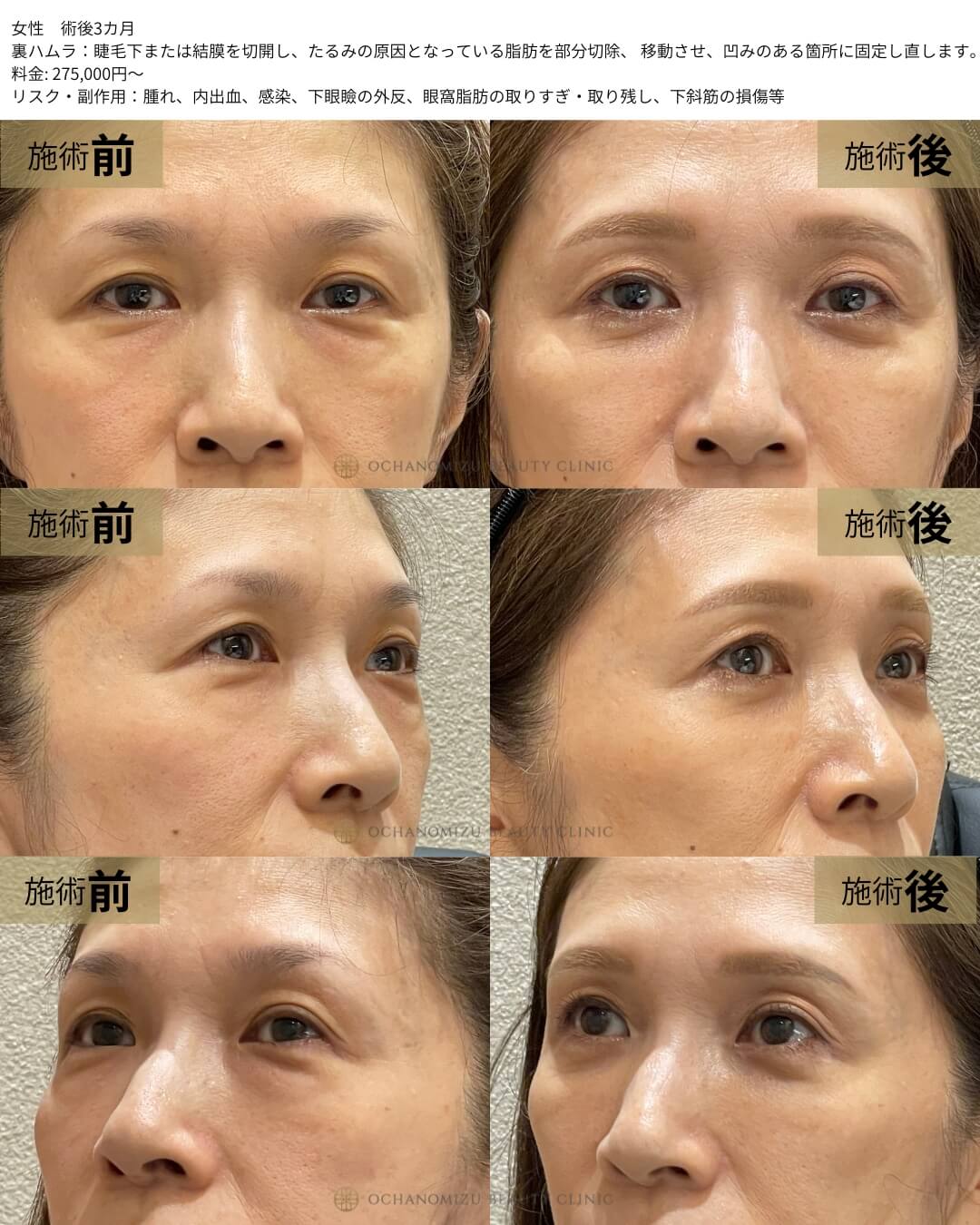 裏ハムラ