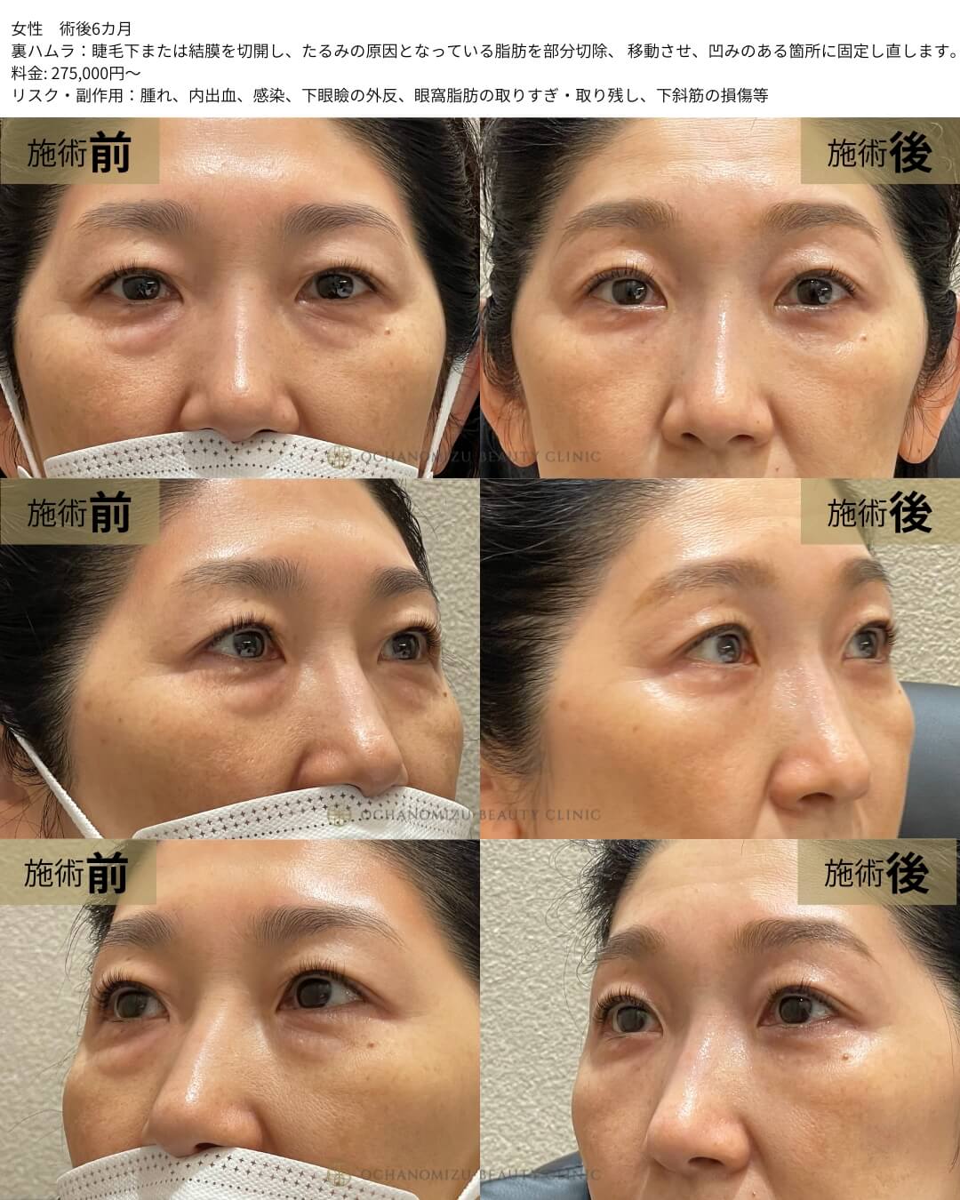 裏ハムラ