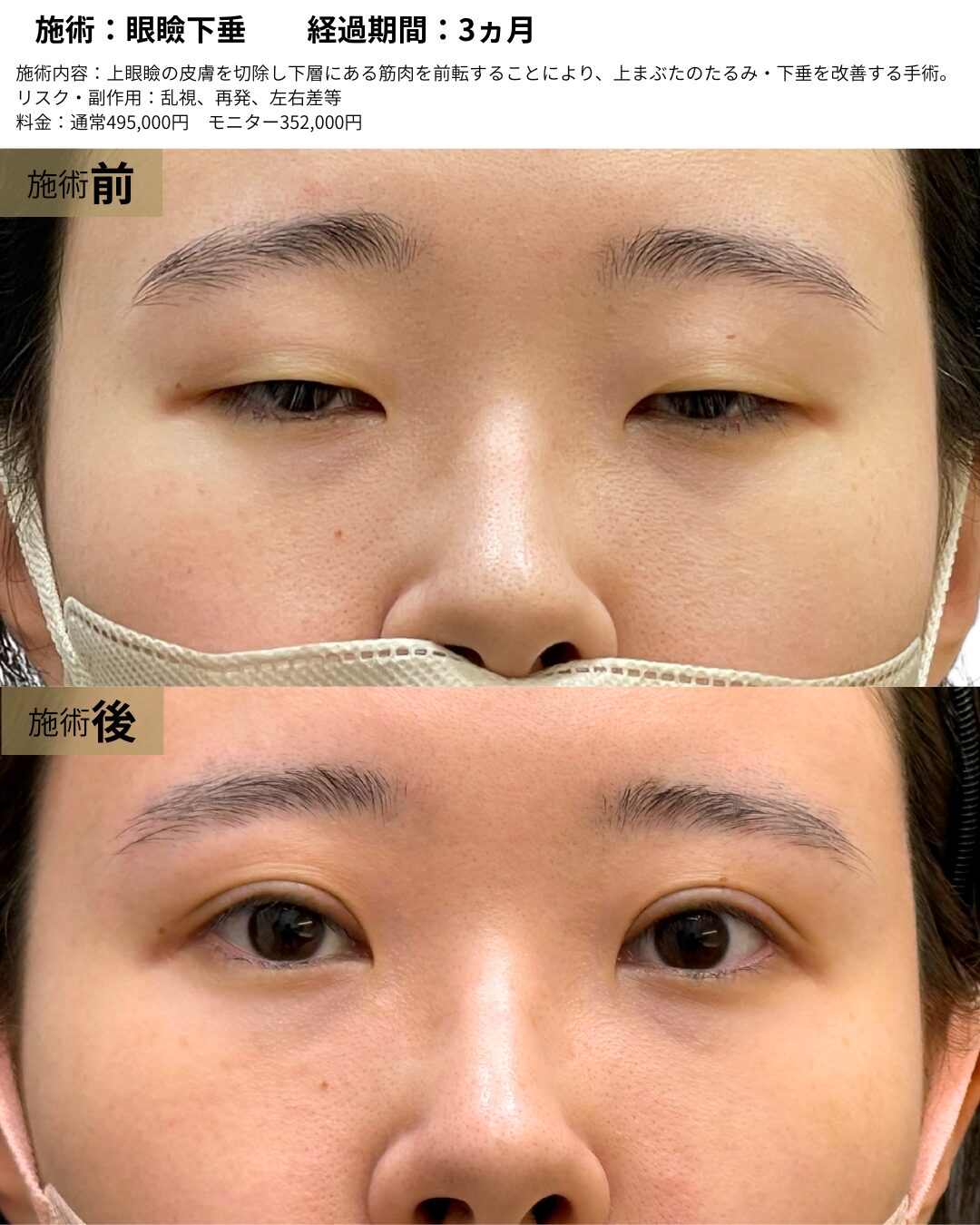 眼瞼下垂