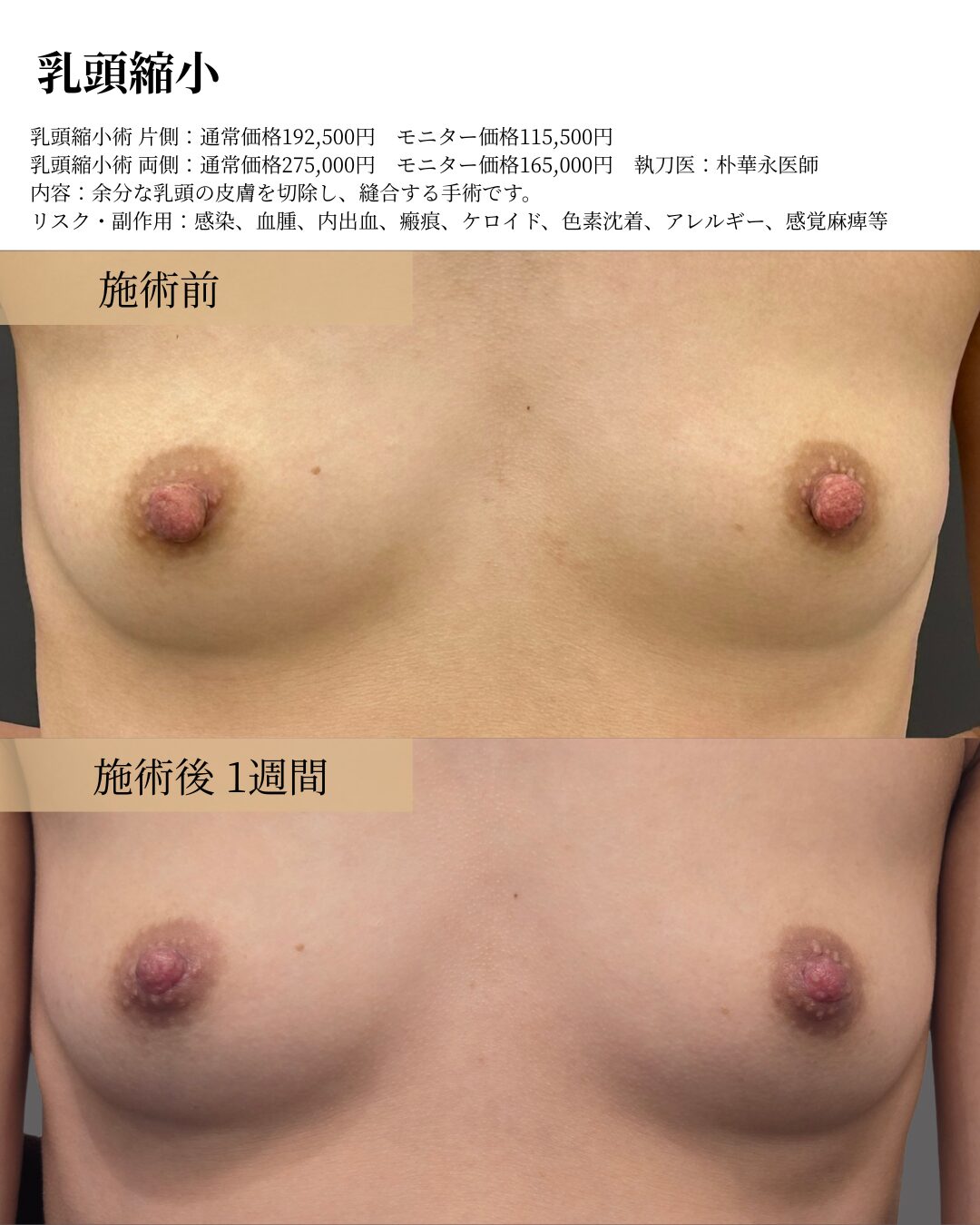 乳頭縮小