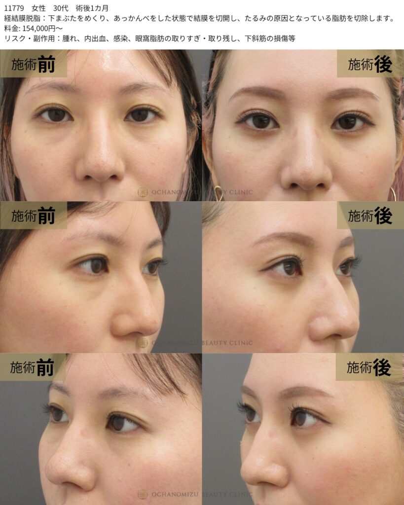 経結膜脱脂