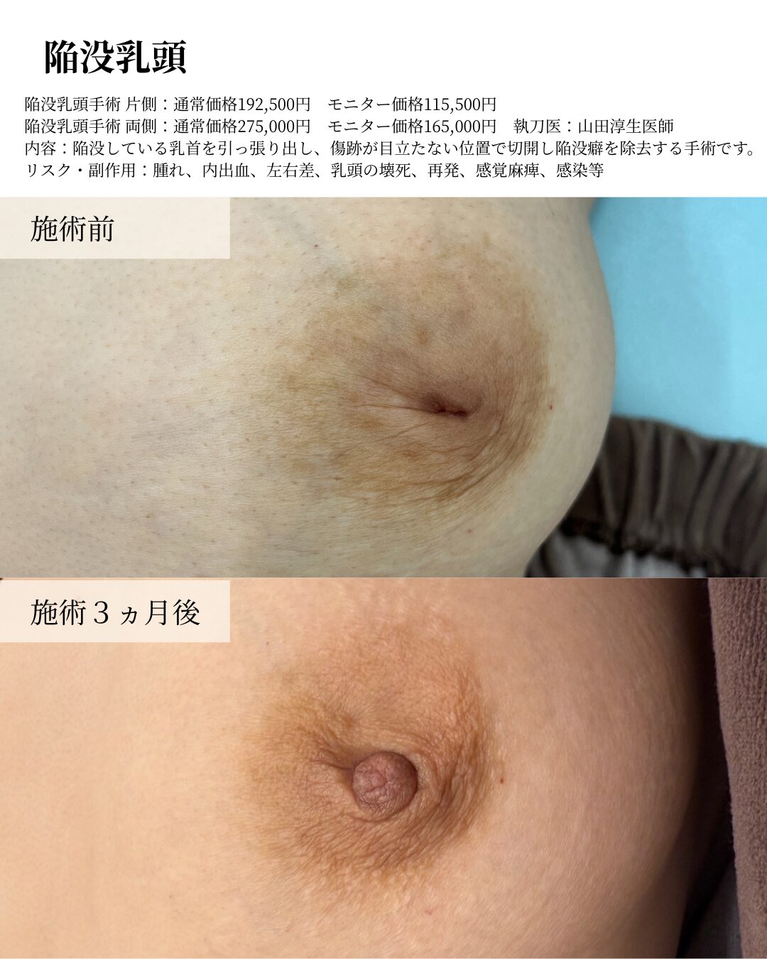 陥没乳頭
