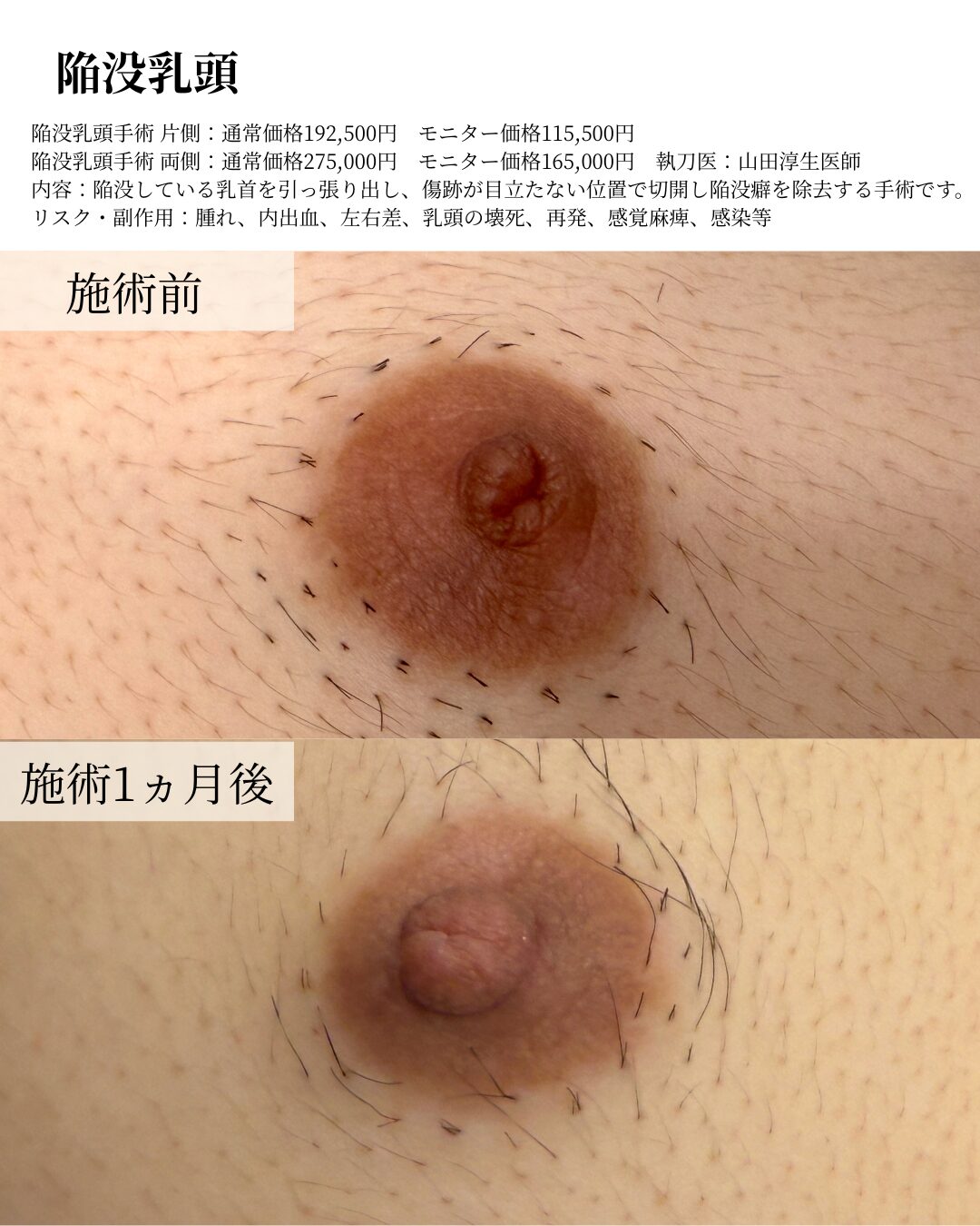 陥没乳頭
