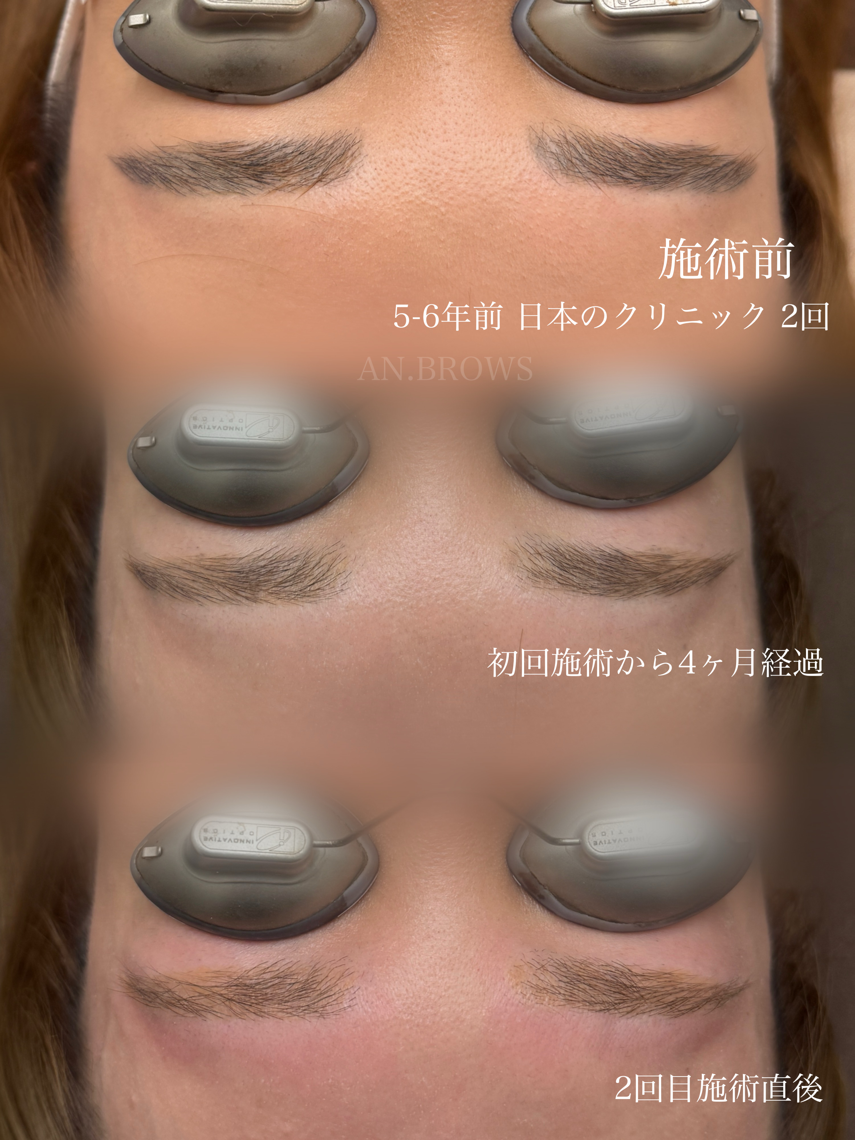 眉アートメイク除去 症例写真