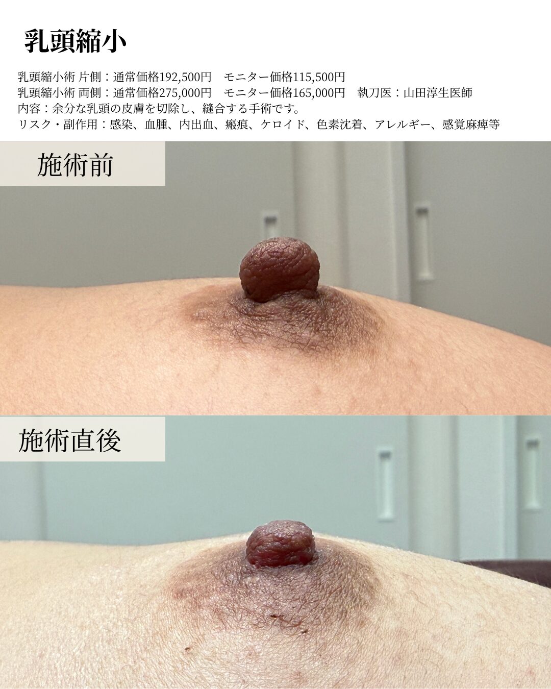 乳頭縮小
