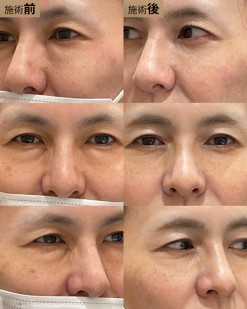 裏ハムラ