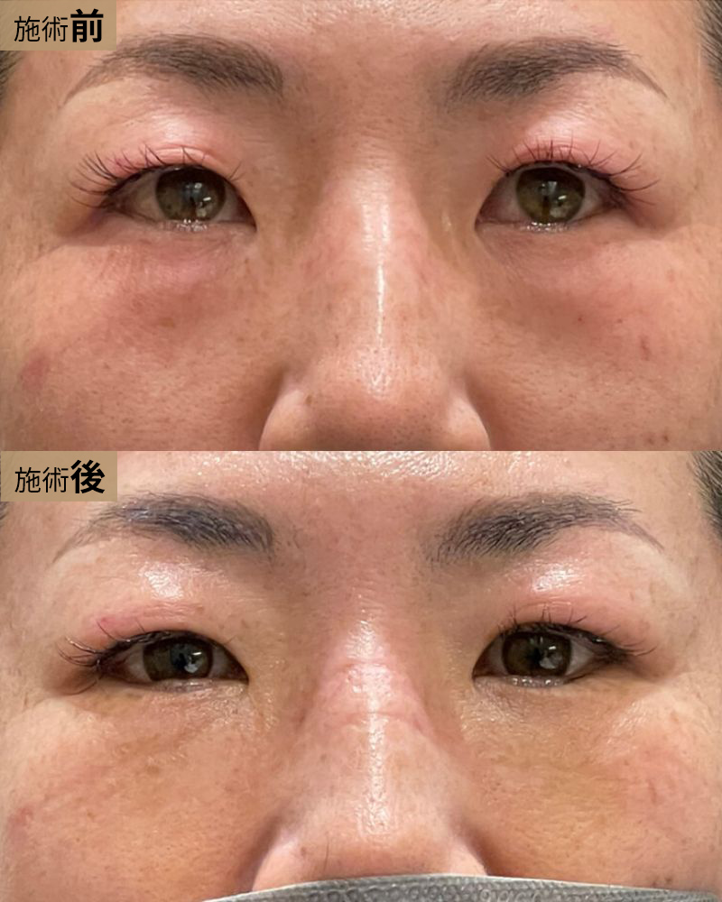 裏ハムラ