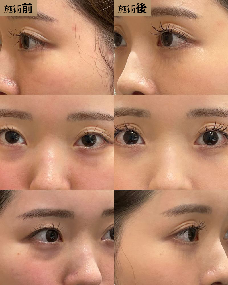 経結膜脱脂