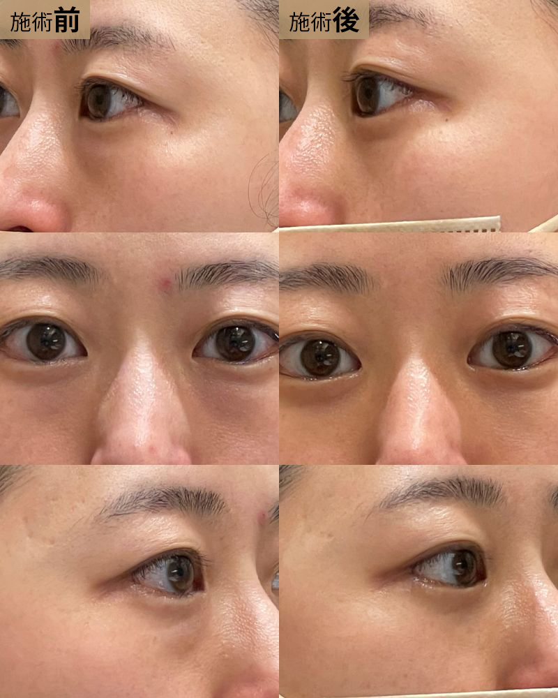 経結膜脱脂