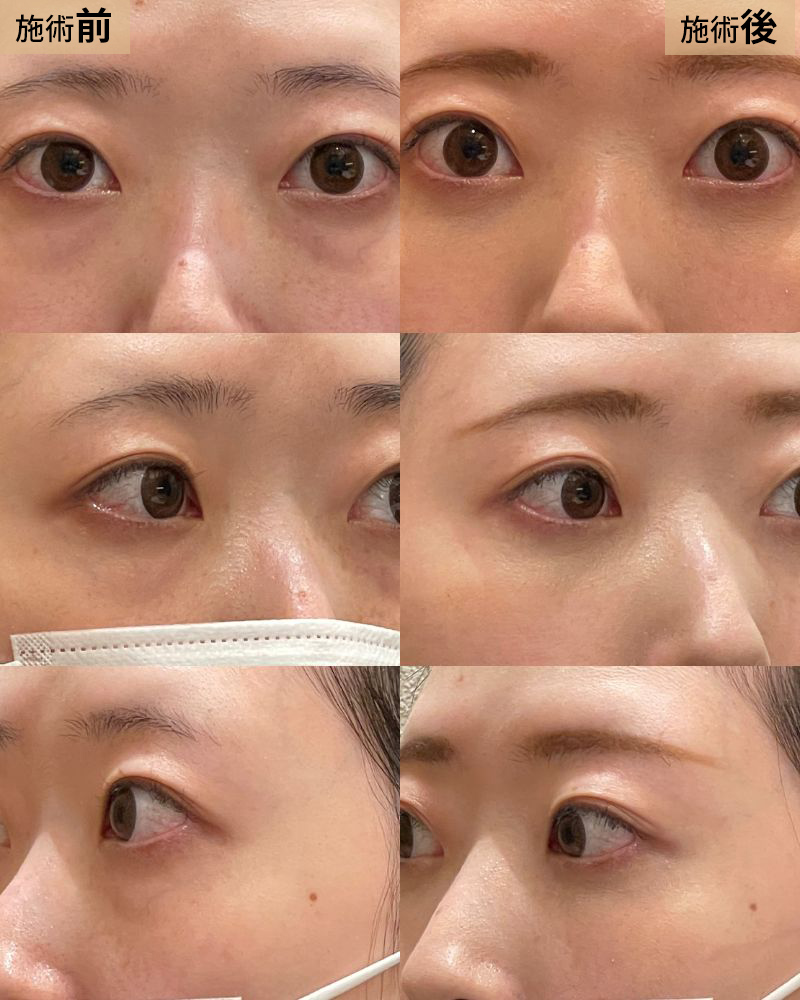 経結膜脱脂