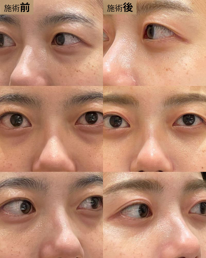 経結膜脱脂
