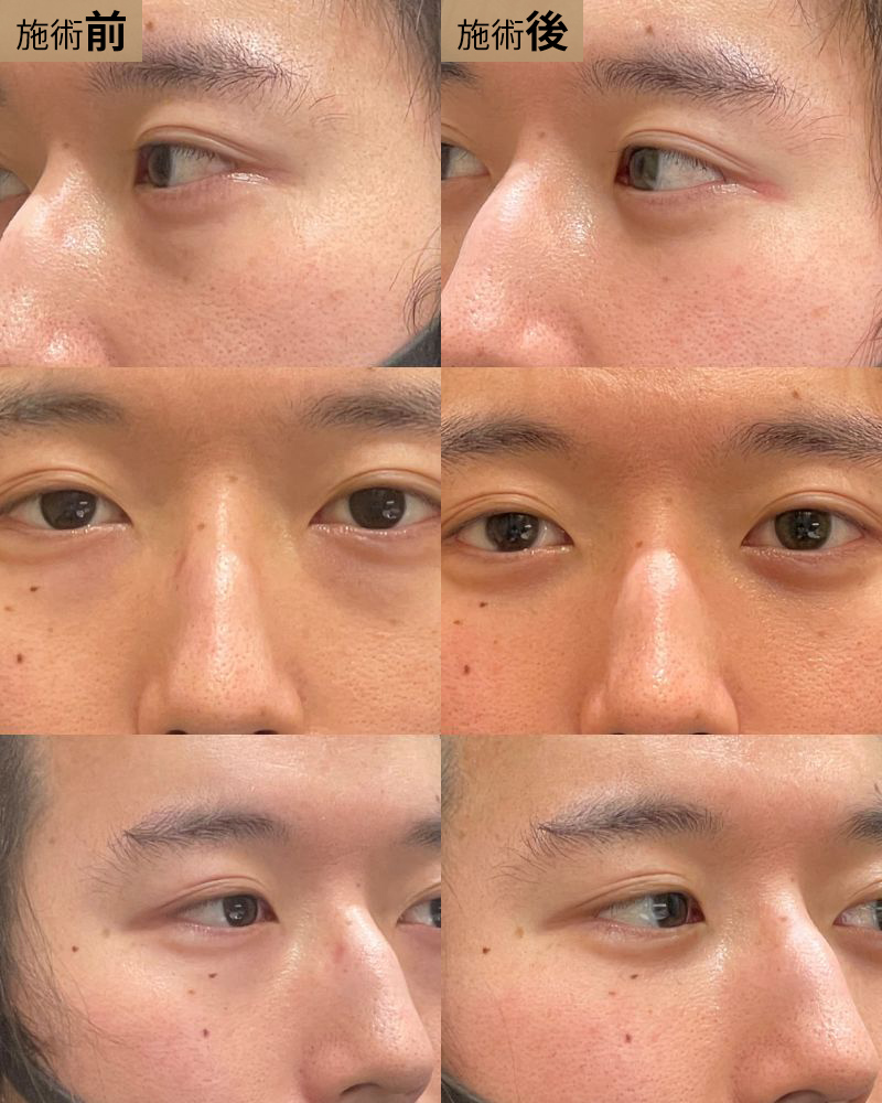 経結膜脱脂