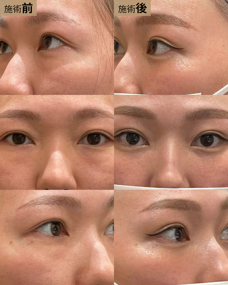 経結膜脱脂