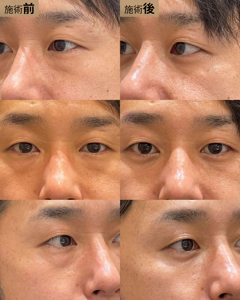 経結膜脱脂