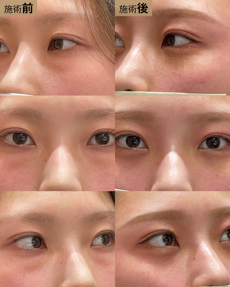 経結膜脱脂