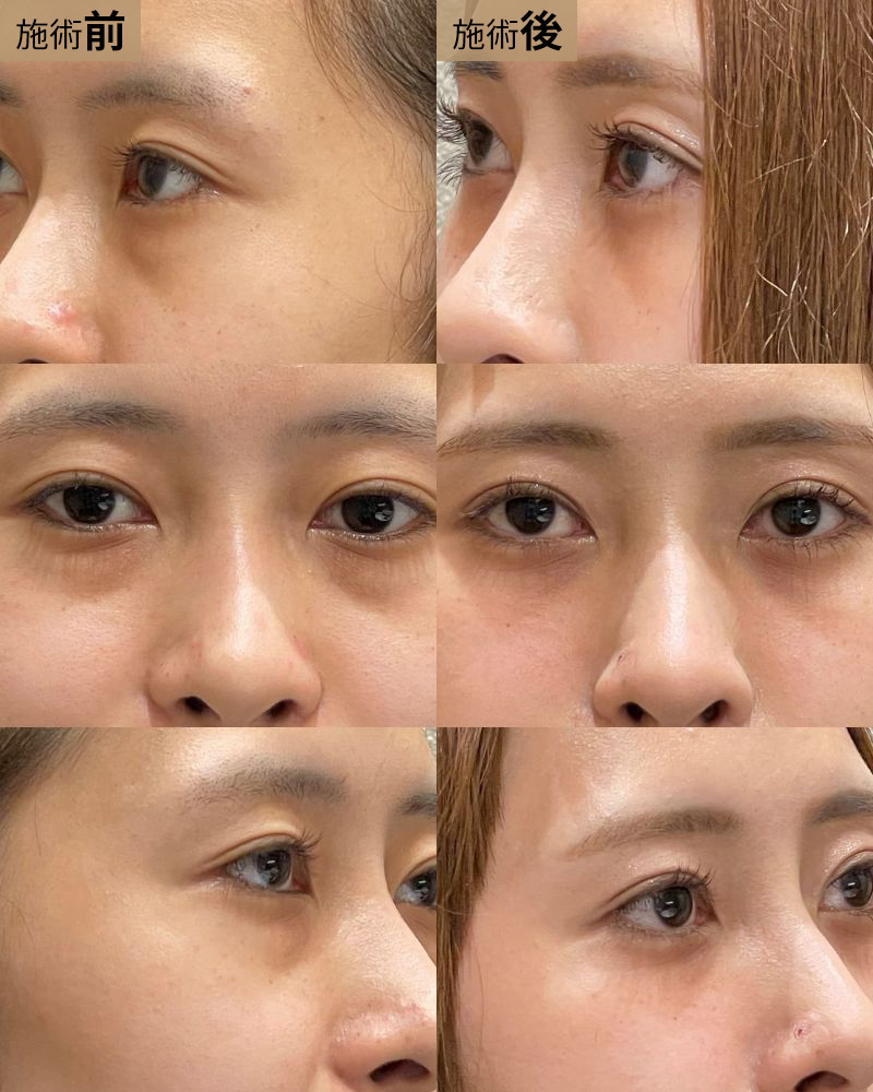 経結膜脱脂