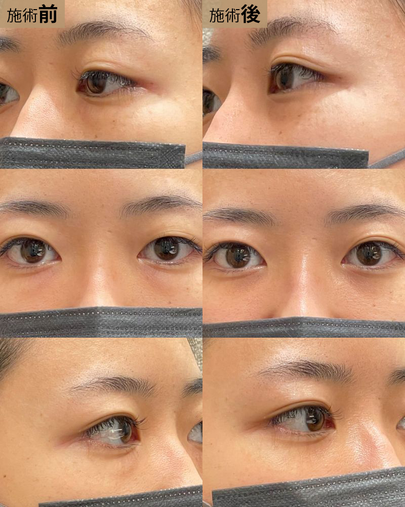 経結膜脱脂